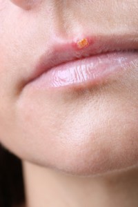 cold sore laser therapy