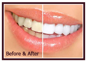 teeth whitening