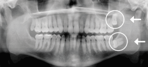 wisdom-teeth-xray